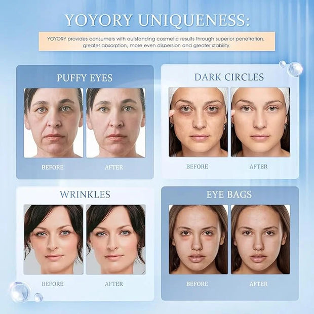 Hydrogel Under Eye Patches - Collagen & Hyaluronic Acid for Removing Eye bags, Puffiness, Dark Circles Smoothing Skin Care...