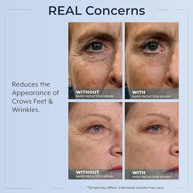Plexaderm Rapid Reduction Eye Serum - Visibly Reduces Under-Eye Bags, Wrinkles, Dark Circles, Fine Lines & Crow's Feet Ins...