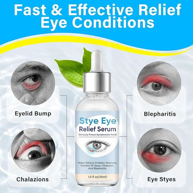 Stye Eye Treatment, Natural Stye Treatment Serum for Styes Chalazion and Blepharitis, Mild & Fast Relief - Product Image
