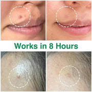 ACROPASS Acne Cure DEN Microarray Patch, OTC Salicylic Acid 2% (4ct) – Acne Treatment for Sensitive Skin, Anti-Inflammatio...