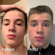 Acne System for Men and Boys, Face Wash, Moisturizer, Pimple Patches, Shield Men's Skin Care Set (1 Month) - Product Image