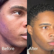 Acne System for Men and Boys, Face Wash, Moisturizer, Pimple Patches, Shield Men's Skin Care Set (1 Month) - Product Image