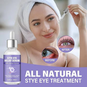 Stye Eye Treatment, Natural Stye Relief Serum, Gently Cleanses Lashes and Eyes, Chalazion and Blepharitis Treatment，Reliev...