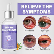 Stye Eye Treatment, Natural Stye Relief Serum, Gently Cleanses Lashes and Eyes, Chalazion and Blepharitis Treatment，Reliev...
