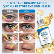 Stye Eye Treatment, Natural Stye Relief Serum for Styes, Chalazions and Blepharitis, Quickly Relieves Eye Irritation and R...