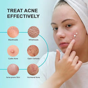 Acne Pimple Spot Treatment Cream: Cystic Hormonal Blackheads Blemish Remover for Face, Back and Body - with 10% Azelaic Ac...