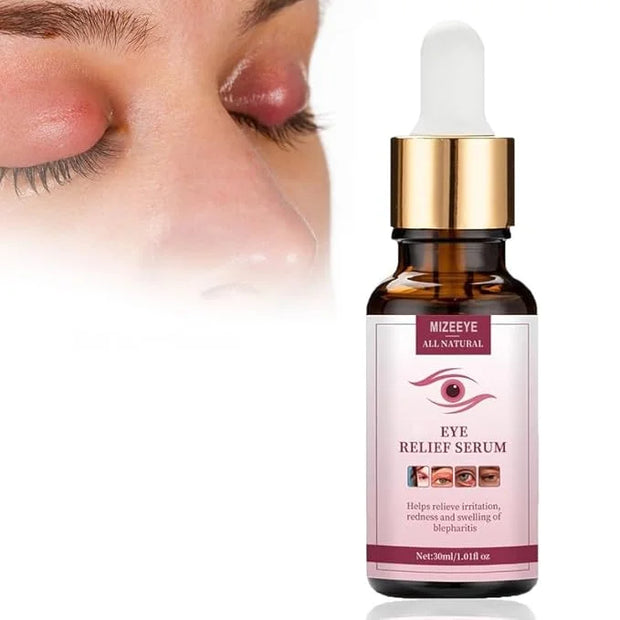 Chalazion Eye Treatment For Blepharitis, 30ml Moisturize Eyelids Serum and Chalazion Remover, Gentle Under Eye Relief Seru...