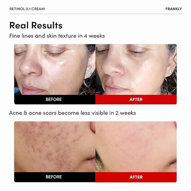 FRANKLY Skin Repair Duo: Retinol 0.3 Cream & Butter So Much Cream | Anti-Aging & Skin Turnover | Deep Moisturization | Veg...