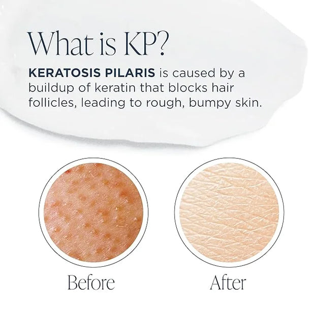 Glytone KP Kit – Exfoliating Body Wash, Glycolic Acid Lotion & Shower Pouf for Keratosis Pilaris – Smooth Rough Bumpy Skin...