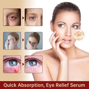 Chalazion Eye Treatment For Blepharitis, 30ml Moisturize Eyelids Serum and Chalazion Remover, Gentle Under Eye Relief Seru...