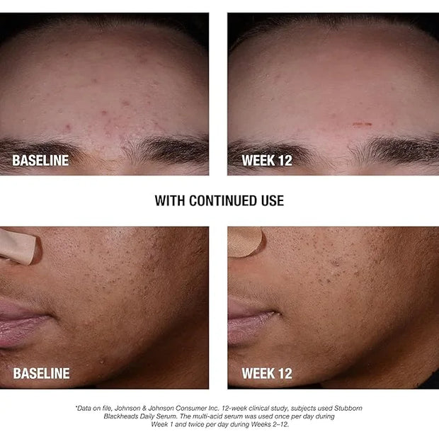 Neutrogena Stubborn Blackheads Daily Acne Facial Serum with Salicylic, Glycolic, Polyhydroxy & Mandelic Acids, Oil-Free Fa...