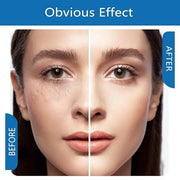 Milia Remover Treatment Serum, Milia Remover for Eyes & Face，Deep Clear to Get Glow Skin 0.85 oz - Product Image