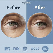 MyHalos Eye Masks for Dark Circles and Puffiness & Eye Patches for Wrinkles Duo- 24 Under Eye Patches for Puffy Eyes, Dark...