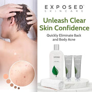 Exposed Skin Care Body Acne Kit – Dual Acne Treatment Serums + Body Wash and Exfoliating Body Cloth – Powerful System Elim...