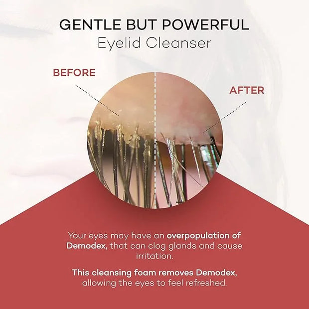 ZocuFoam Eyelid Cleanser - Foaming Eyelid Scrub - Natural pH Balanced Solution - 1.7 FL OZ (50mL) - Product Image