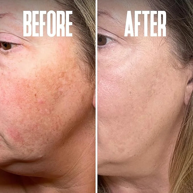Save 18% on The Skin Care Solution For Dark Spots, Razor Bumps, Ingrown Hair & Razor Burns – Includes Our Ultra Potent Bri...