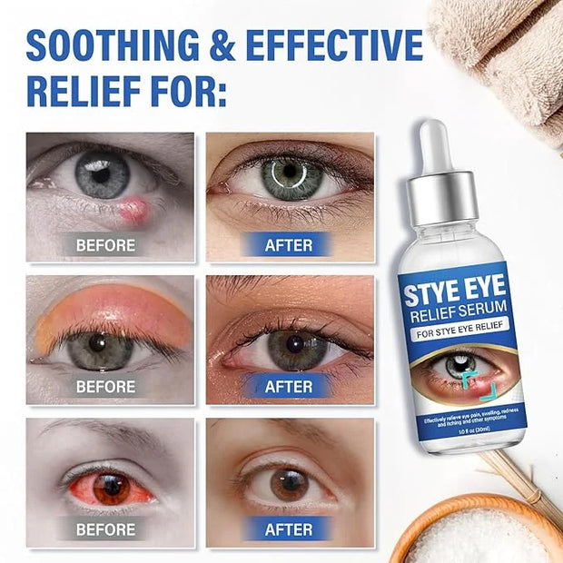St＿ye Eye Treatment, Natural Eye Serum for Chalazion and Blepharitis Treatment, Leading to Soothed and Restored E-ye Areas...