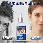 Stye Eye Treatment, Natural Stye Remover, Eye Stye Relief Serum, Premium Formula - Gentle Cleanser for Chalazion & Blephar...