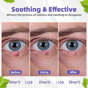 Stye Eye Treatment, Natural Relief Drops Serum for Styes Chalazion and Blepharitis, Fast Chalazion Remover for Restore Hea...