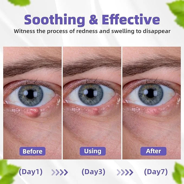 Stye Eye Treatment, Natural Relief Drops Serum for Styes Chalazion and Blepharitis, Fast Chalazion Remover for Restore Hea...