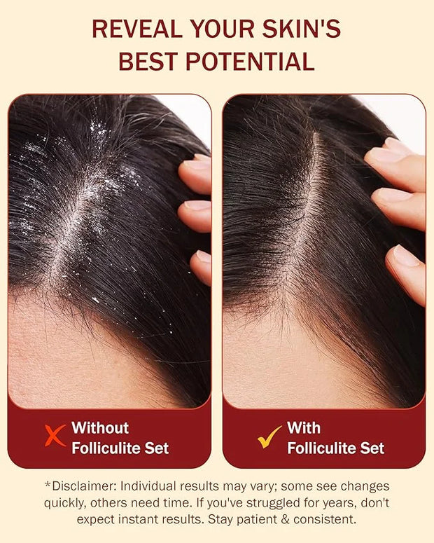 3% BHA Folliculitis Shampoo - Clarifying Shampoo with Salicylic Acid, Tea Tree Oil & Chamomile Extracts - Ideal for Flaky,...