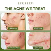 Exposed Skin Care Body Acne Kit – Dual Acne Treatment Serums + Body Wash and Exfoliating Body Cloth – Powerful System Elim...