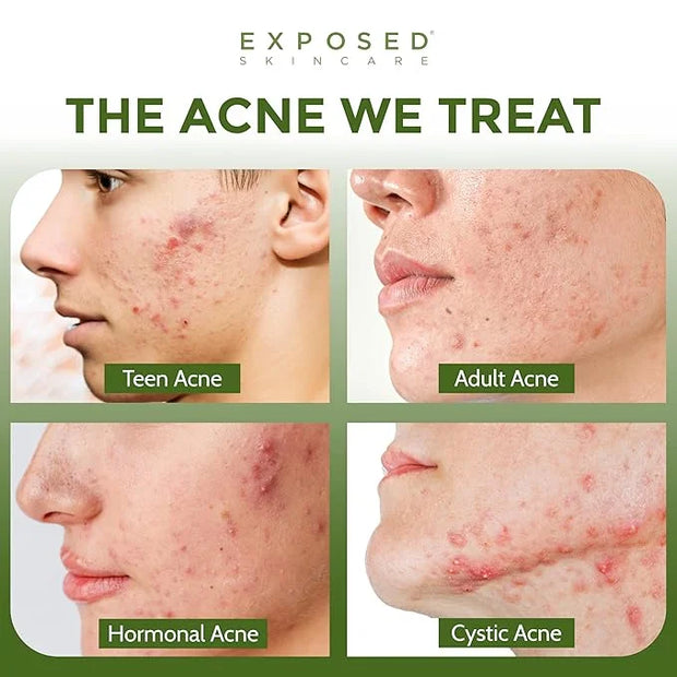 Exposed Skin Care Body Acne Kit – Dual Acne Treatment Serums + Body Wash and Exfoliating Body Cloth – Powerful System Elim...