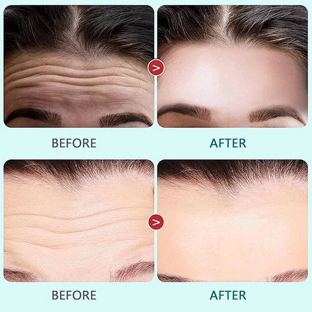 2PCS Reusable Forehead Wrinkle Patches Silicone Forehead Patches Anti-Wrinkle, Wrinkles Treatment for Wrinkles & Fine Line...