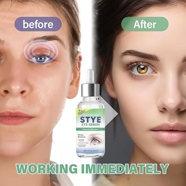 Stye Eye Treatment, Effective Stye Eye Drops Serum for Styes Chalazion and Blepharitis, Fast Chalazion Remover for Restore...