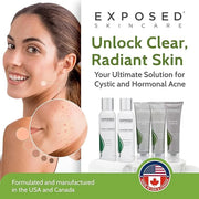Exposed Skin Care Expanded Acne Treatment Kit - Includes Salicylic Acid Face Wash, Clearing Tonic, Treatment Serum with Be...
