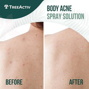 Salicylic Acid Back & Body Acne Spray, Back Acne Solution For Women And Men, Acne Body Spray with Tea Tree Oil, Fast-Dryin...