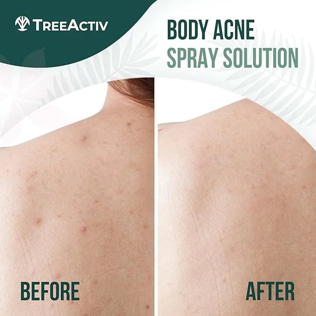 Salicylic Acid Back & Body Acne Spray, Back Acne Solution For Women And Men, Acne Body Spray with Tea Tree Oil, Fast-Dryin...