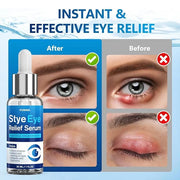 Stye Eye Treatment Serum, Eye Stye Remover for Chalazion, Blepharitis & Stye Removal, Natural Stye Eye Drops, Safe & Fast ...