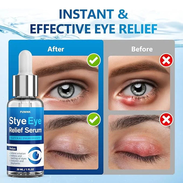 Stye Eye Treatment Serum, Eye Stye Remover for Chalazion, Blepharitis & Stye Removal, Natural Stye Eye Drops, Safe & Fast ...