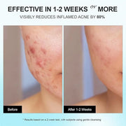 Acne Pimple Spot Treatment Cream: Cystic Hormonal Blackheads Blemish Remover for Face, Back and Body - with 10% Azelaic Ac...