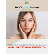 VoilaVe Pure Hypochlorous Acid Serum, Anti-Wrinkle Hypochlorous Acid Face Serum for Redness - Reduce Dryness, Skin Irritat...