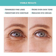 FOREO IRIS Hydrating Hydrogel Eye Mask - Dark Circles Under Eye Treatment for Women & Men - Puffy Eyes Treatment - Hydrati...