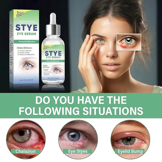 Stye Eye Treatment, Effective Stye Eye Drops Serum for Styes Chalazion and Blepharitis, Fast Chalazion Remover for Restore...