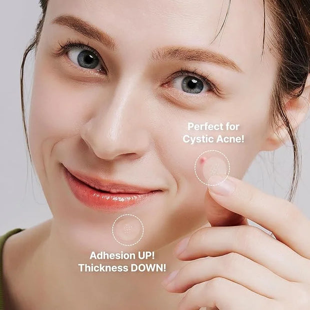 ACROPASS Acne Cure DEN Microarray Patch, OTC Salicylic Acid 2% (4ct) – Acne Treatment for Sensitive Skin, Anti-Inflammatio...