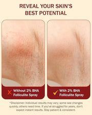 2% BHA Folliculitis Body Oil Spray - Salicylic Acid Body Mist with Tea Tree Oil & Aloe Vera - Spray Moisturizer for Dry Sk...