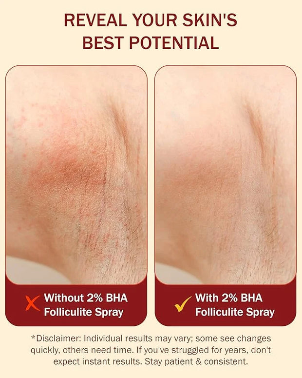 2% BHA Folliculitis Body Oil Spray - Salicylic Acid Body Mist with Tea Tree Oil & Aloe Vera - Spray Moisturizer for Dry Sk...