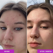 Good Molecules Niacinamide Serum - 10% Niacinamide Balancing B3 Facial Serum for Acne, Tone, Texture - Brightening and Hyd...