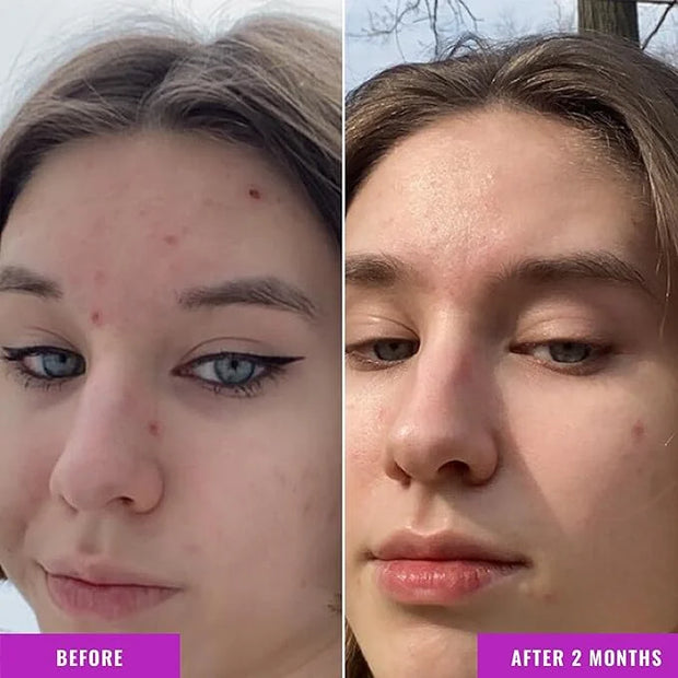 Good Molecules Niacinamide Serum - 10% Niacinamide Balancing B3 Facial Serum for Acne, Tone, Texture - Brightening and Hyd...