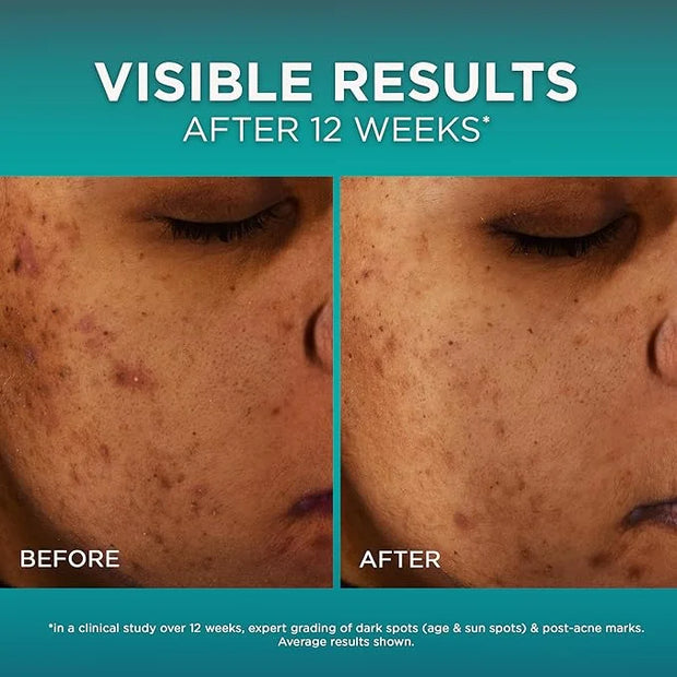 L’Oréal Paris Bright Reveal 12% [Niacinamide + Amino Sulfonic + Ferulic] Dark Spot Serum 1oz + Moisturizer Sample - Produc...
