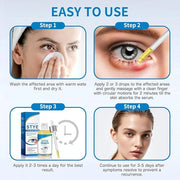 Stye Eye Treatment, Natural Stye Relief Serum for Styes, Chalazions and Blepharitis, Quickly Relieves Eye Irritation and R...