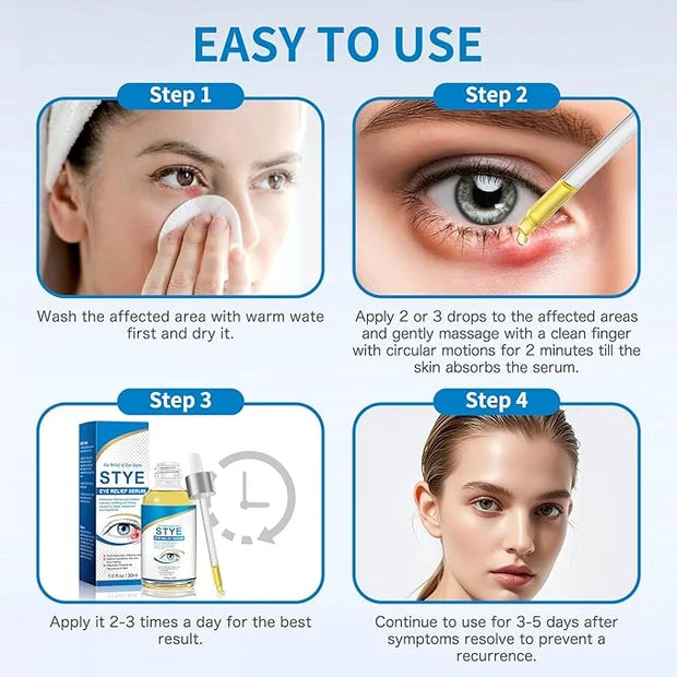 Stye Eye Treatment, Natural Stye Relief Serum for Styes, Chalazions and Blepharitis, Quickly Relieves Eye Irritation and R...