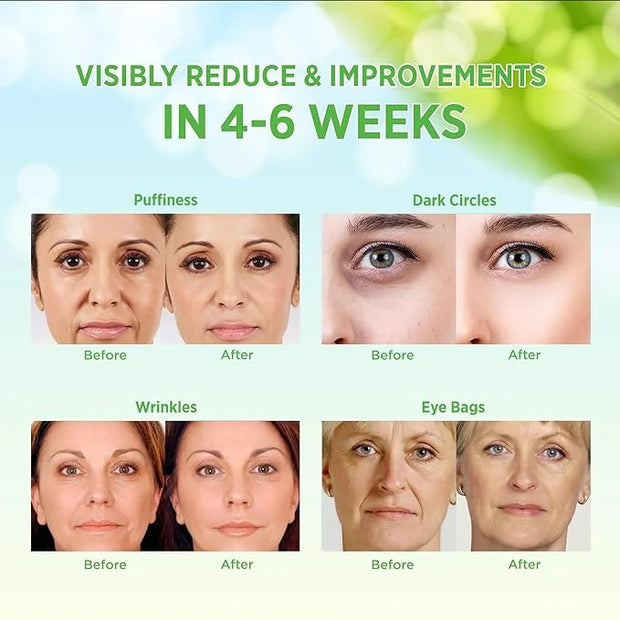 VELAMO ADVANCED Under Eye Patches: Aloe Vera Under Eye Mask for Dark Circles - Retinol Eye Patches for Wrinkles and Puffin...