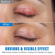 Stye Eye Treatment, Natural Stye Eye Relief Serum, for Styes Chalazion and Blepharitis Treatment, Restored Healthier Eye S...