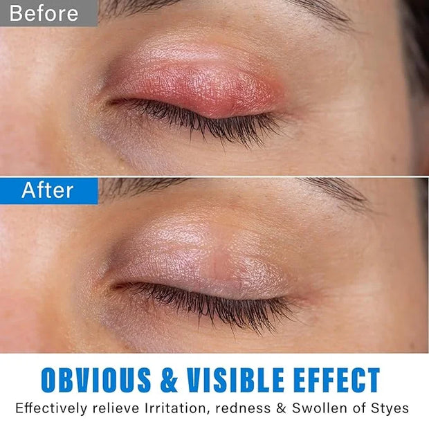Stye Eye Treatment, Natural Stye Eye Relief Serum, for Styes Chalazion and Blepharitis Treatment, Restored Healthier Eye S...
