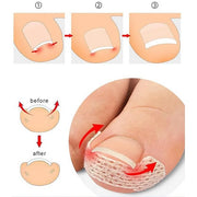 Ingrown Toenail Treatment: 120Pcs Breathable